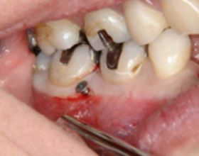 歯根の間への適用