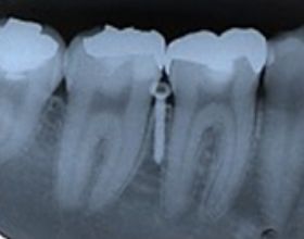 歯根の間への適用